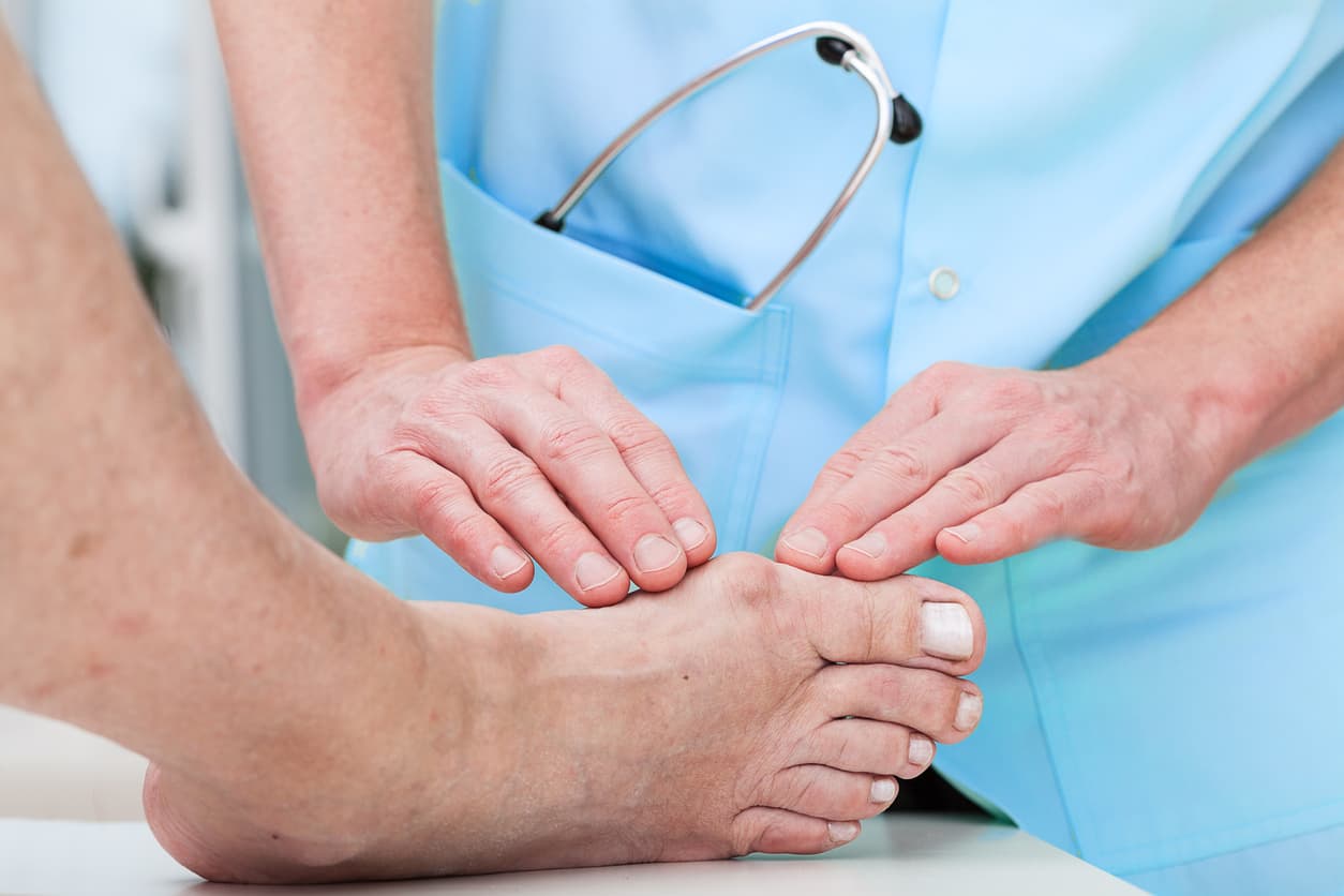 Orthopaedist at work treating a bunion, stock photo